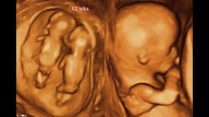 What Is A Fetal Anomaly Scan?
